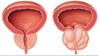 Prostate enlargement